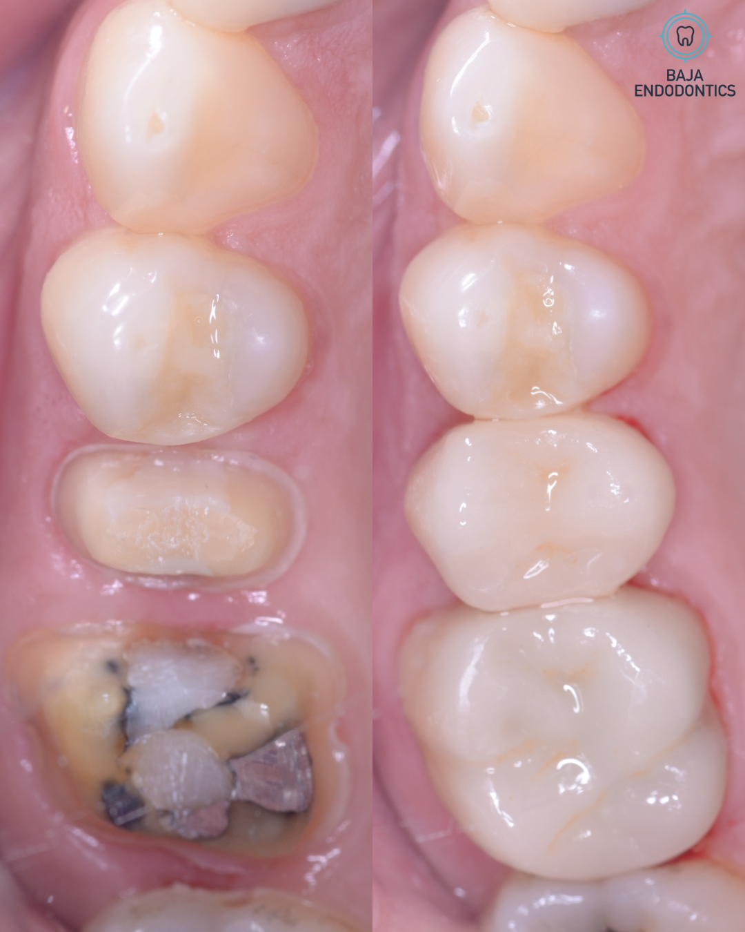 Molar restored with a crown
