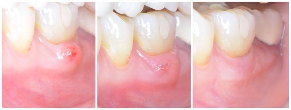 Abscess evolution